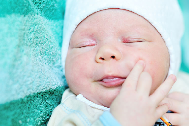 Stork mark (capillary haemangioma) on eyelids