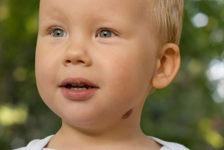 Strawberry mark (cavernous haemangioma) under left jaw